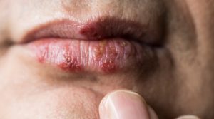 Symptoms of Herpes